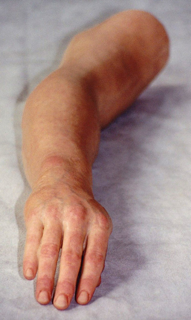 Prosthetic Arm 3
