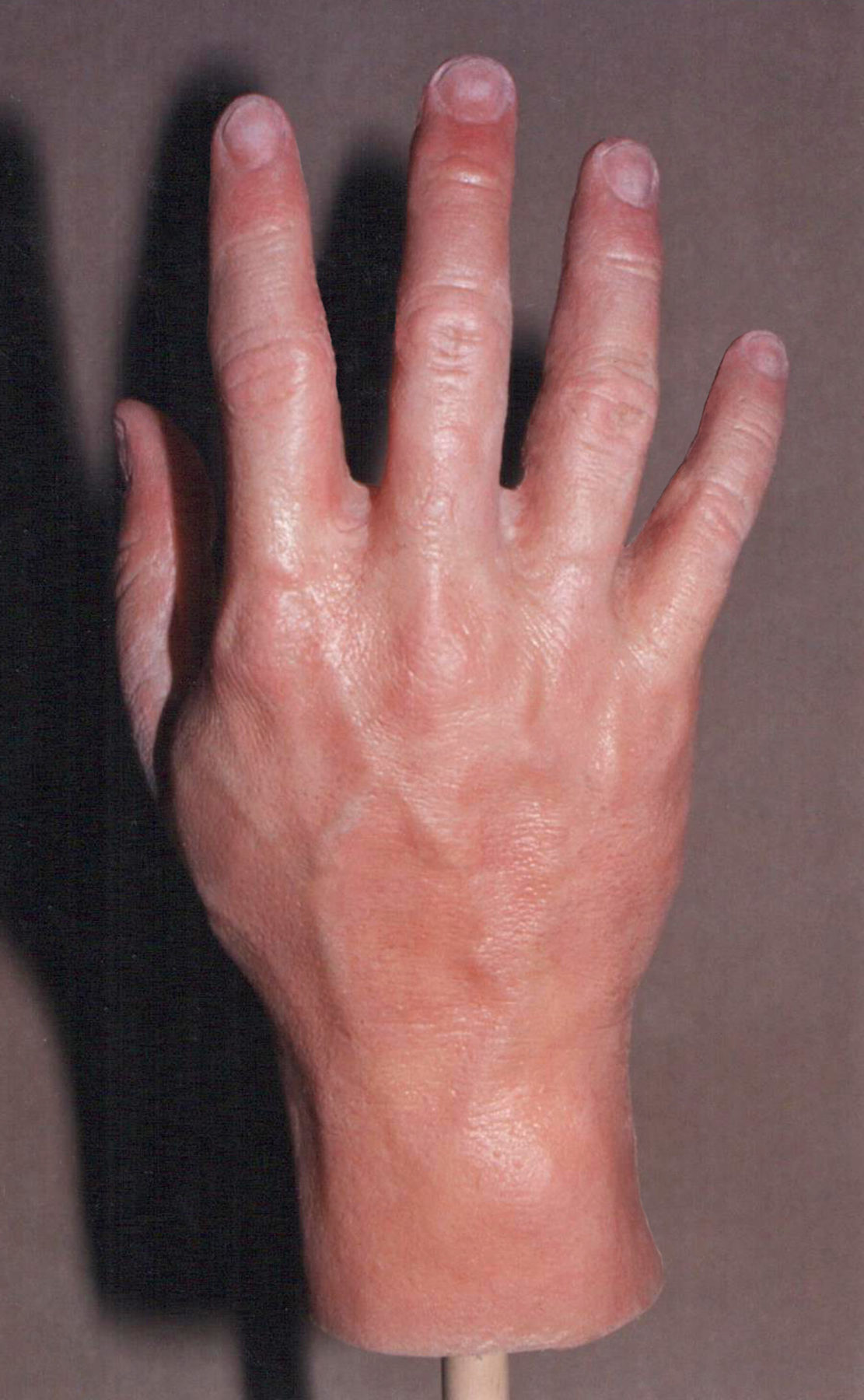 Prosthetic Hand 1